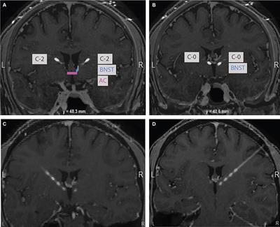 Case report: Clinical efficacy of deep brain stimulation contacts corresponds to local field potential signals in a patient with obsessive-compulsive disorder